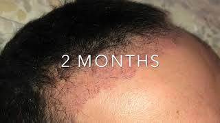 Trapianto Capelli Giorno per Giorno da giorno 1 a 6 mesi  Hair transplant Day By Day [upl. by Asselem520]