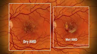 Macular Degeneration  an animated explanation [upl. by Eartha]