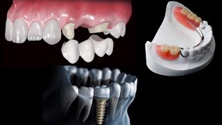 Como Recolocar Dentes Perdidos  Implantes Dentários e Próteses Dentárias [upl. by Assirahc430]