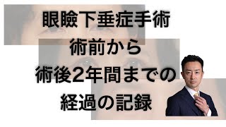 📷眼瞼下垂症手術後の腫れの経過：手術直後から2年後まで追跡👨‍⚕️ [upl. by Marie]