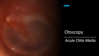 Acute Otitis Media Otoscopy [upl. by Nue]