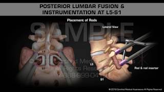 Posterior Lumbar Fusion amp Instrumentation at L5S1 [upl. by Annez152]