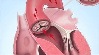 Understanding Aortic Stenosis with Dr Marc Gillinov [upl. by Arabeila]