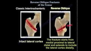 Subtrochanteric Femur Fractures  Everything You Need To Know  Dr Nabil Ebraheim [upl. by Emina]