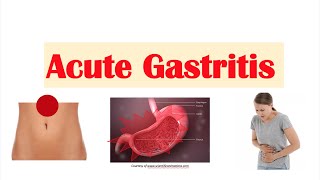 Acute Gastritis Stomach Inflammation  Causes Signs amp Symptoms Diagnosis Treatment [upl. by Soiritos]