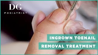 Ingrown toenail removal treatment [upl. by Aleksandr]