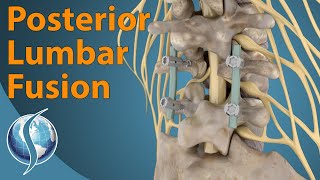 Posterior Lumbar Fusion [upl. by Collier70]