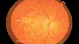 Macular Degeneration and the Aging Retina [upl. by Sower]