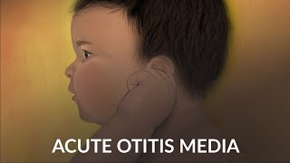 Acute Otitis Media by A Ruan J Cheng  OPENPediatrics [upl. by Eardnaed749]