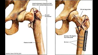 Intertrochanteric Fractures [upl. by Huskey]