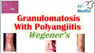 Granulomatosis with Polyangiitis Wegener’s granulomatosis  Symptoms Diagnosis Treatment [upl. by Bergeman]