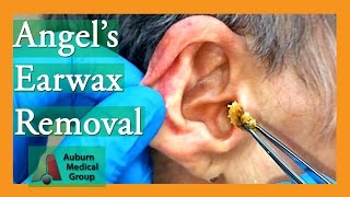 Angels Earwax Removal  Auburn Medical Group [upl. by Letnuahs588]