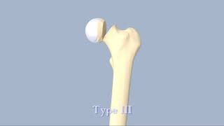 Hip Fractures [upl. by Fezoj]