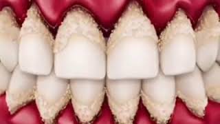 Gingivitis  Gum Disease  Wobbly Teeth [upl. by Yttisahc]