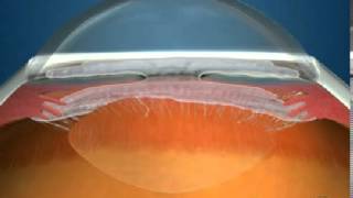 Elbromboly Basic ophthalmology IC Glaucoma  Introduction [upl. by Okechuku]