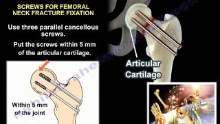 Fracture Healing  Everything You Need To Know  Dr Nabil Ebraheim [upl. by Krilov]