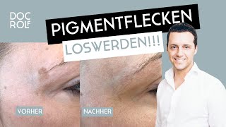 Cryopen entfernt Pigmentflecken sicher amp schnell [upl. by Dash]