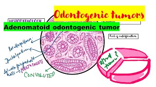 Adenomatoid odontogenic tumor HISTOPATHOLOGYradiographic featuresclinical featuresTreatment [upl. by Koziarz]