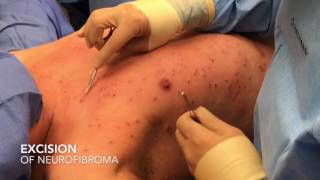 Dr Pimple Popper  Removing Five 35 Year Old Cysts [upl. by Acinemod284]