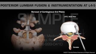 Posterior Lumbar Fusion amp Instrumentation at L45 [upl. by Andersen]