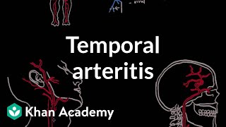 Takayasu arteritis  Circulatory System and Disease  NCLEXRN  Khan Academy [upl. by Milah]