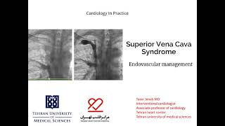 SVC syndrome Endovascular management [upl. by Asiaj]