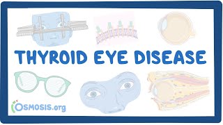 Thyroid Eye Disease causes symptoms diagnosis treatment pathology [upl. by Geis]