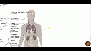 Extrapulmonary TB [upl. by Oglesby351]