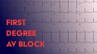 First Degree AV Block  EKG ECG Interpretation [upl. by Lizette]