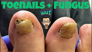 HOW TO CUT THICK TOENAILS WITH FUNGUS [upl. by Smith]