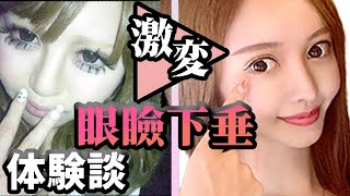 眼瞼下垂の体験談。Before・After・病院名あり【美容整形・整形】 [upl. by Guerra]