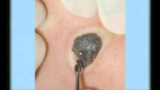 Seborrheic Keratosis Treatment [upl. by Fein]