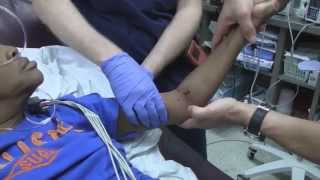 Posterior Elbow Dislocation Reduction [upl. by Yakcm]