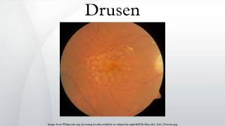 Drusen [upl. by Strohbehn982]