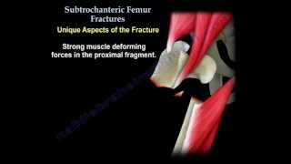 03 Proximal femur Intertrochanteric fracture Clinical amp Radiology amp Classification [upl. by Ellenuahs]