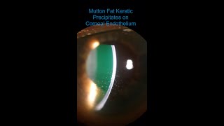 Intermediate Uveitis  Vitritis amp Mutton Fat KPs [upl. by Nyrtak605]