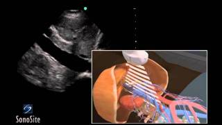 How to Inferior Vena Cava Ultrasound Exam 3D Video [upl. by August754]