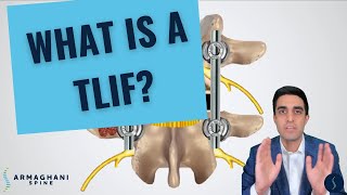 How I perform a TLIF and what to expect after [upl. by Sansbury191]