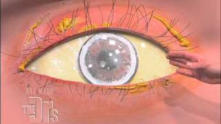 Cholesterol Deposits in the Eye The Doctors [upl. by Weir]