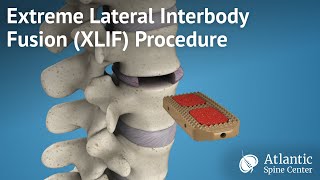 Extreme Lateral Interbody Fusion XLIF Procedure [upl. by Wrigley208]