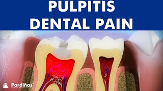 Pulpitis  Inflammation of tooth pulp © [upl. by Libre]