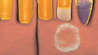 Animation of Wet and Dry Macular Degeneration [upl. by Griffin]