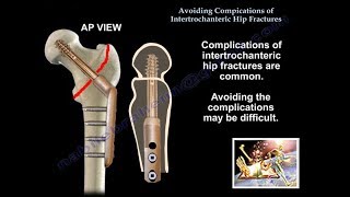 7 Elbow fracture exercise for Quick Improvement [upl. by Anivad]