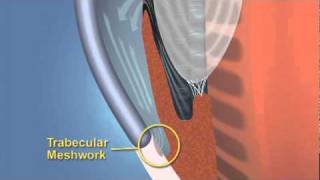 Closed Angle Glaucoma [upl. by Alamat332]