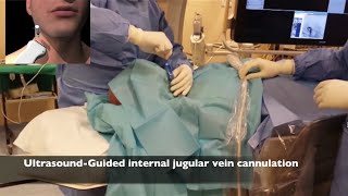 Inferior Vena Cava Filter Placement [upl. by Aseeram]