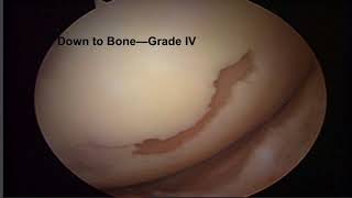 Knee Chondromalcia and Its Treatment [upl. by Mylan]