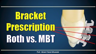 Using Roth and MBT brackets [upl. by Esyned709]