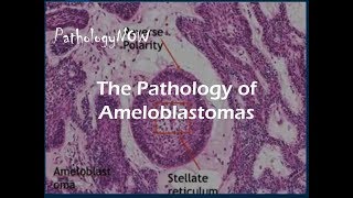 The Pathology of Ameloblastomas [upl. by Kavanagh]