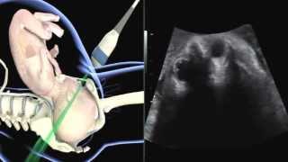 ISUOG how to perform ultrasound in labor assessment of fetal occiput position [upl. by Mchenry]