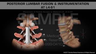 Posterior Lumbar Fusion amp Instrumentation at L4S1 [upl. by Nilrak]